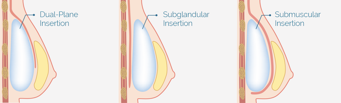 Breast Augmentation