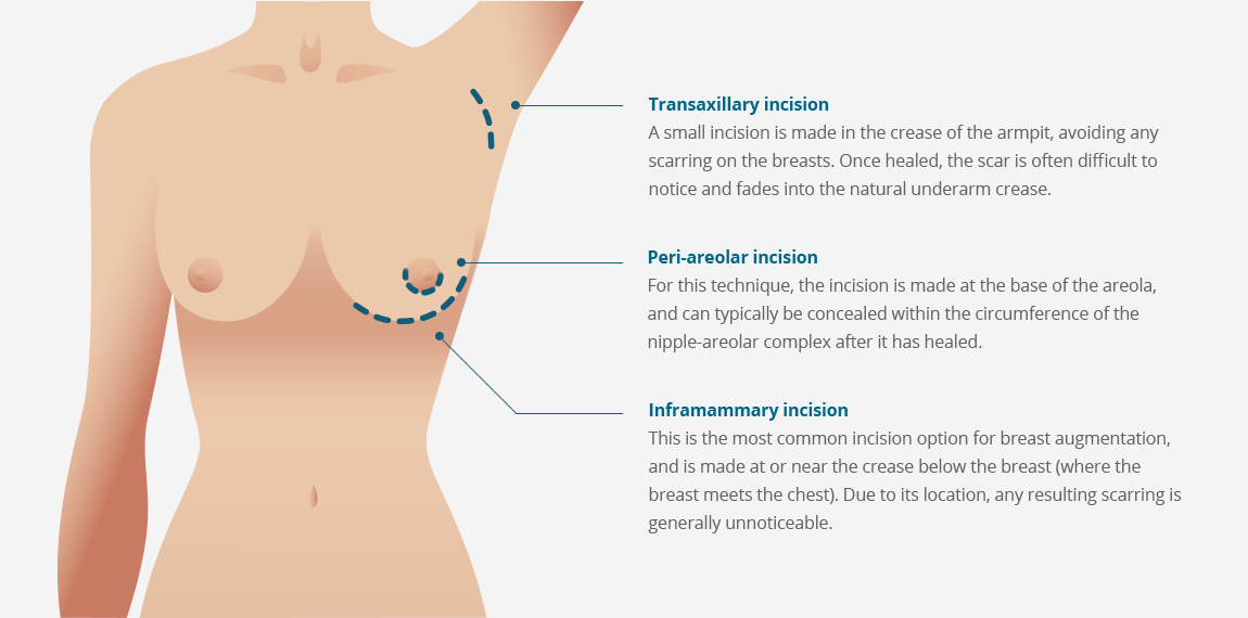 Augmentation Diagram